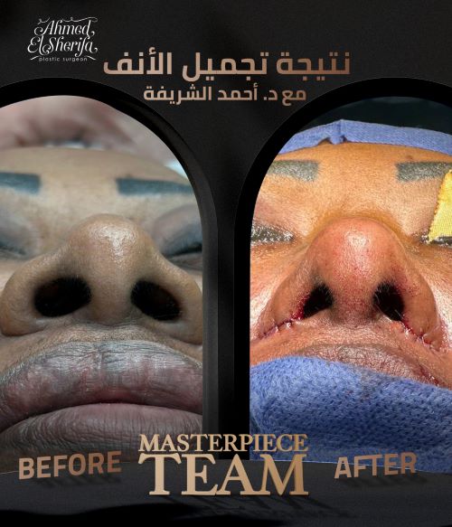 الفرق بين تجميل الأنف الجراحي وغير الجراحي